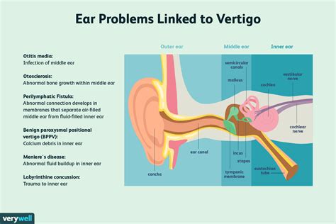 28+ neu Sammlung Inner Ear Dizziness Exercises / Can Tinnitus Lead to ...