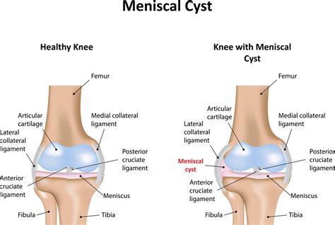 Meniscal-Cyst copy