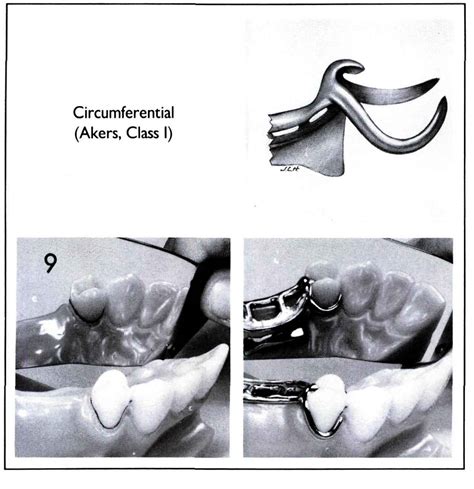 Partial Denture Clasp Types