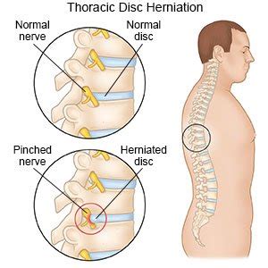 Thoracic Disc Herniation - What You Need to Know