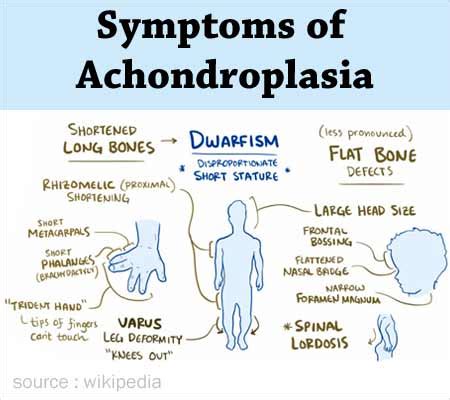 Achondroplasia Symptoms And Characteristics