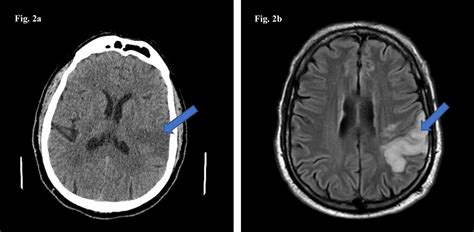 Cureus | Acute Ischemic and Hemorrhagic Stroke in COVID-19: Mounting ...