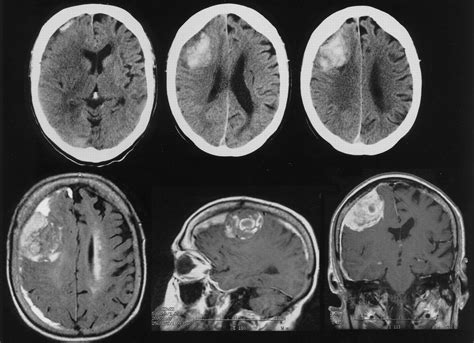 Detecting brain hemorrhage in Computed Tomography (CT) imaging | by ...