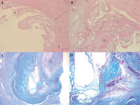 Figure 3 from Symptomatic ganglion cyst of ligamentum flavum as a late ...