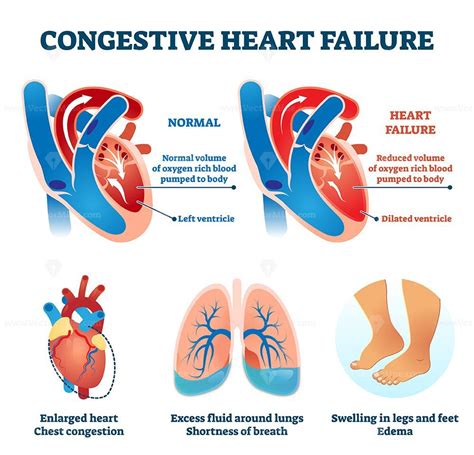 Ann Strickland Viral: What Is Diastolic Heart Failure Symptoms