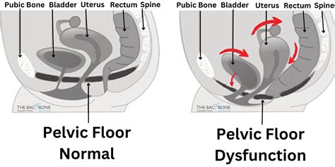 Pelvic Floor Dysfunction/Prolapse | The Backbone Osteopath Southgate