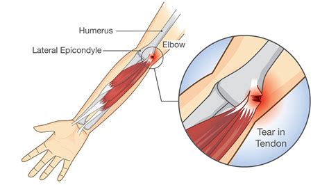 Tennis Elbow Surgery