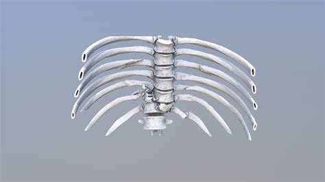 Fracture of the spine type C - 3D model by Innowise: 2D/3D Design and ...