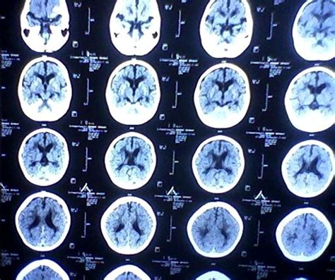 CT brain findings of one case showing diffuse brain atrophy. | Download ...