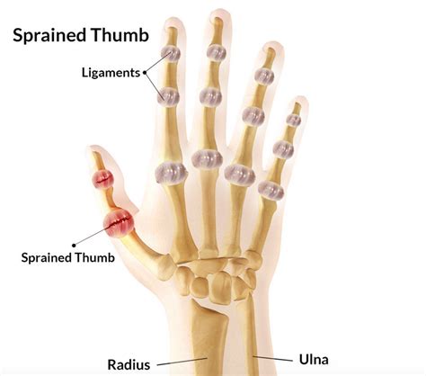 Sprained Thumb | Symptoms, treatment, rehabilitation & taping | SportsMD