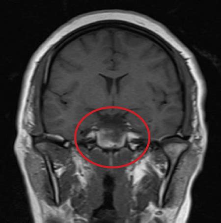 Microprolactinoma | Consultant360