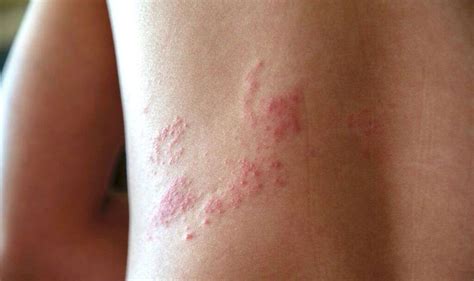 Shingles: 10 Shingles Symptoms