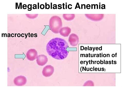 Megaloblastic Anemia - Causes, Symptoms, Treatment