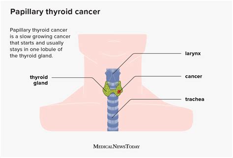 Papillary thyroid cancer (PTC): Symptoms and more