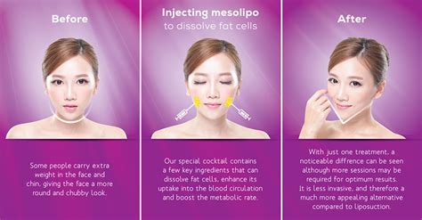 Meso Lipo Face Slimming - Clinic MF