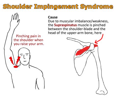 Shoulder impingement syndrome treatment with 4 exercises – Artofit