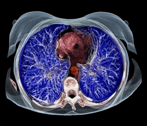 Leveraging Paranasal, Chest CT in Severe Asthma - Pulmonology Advisor