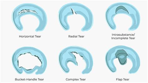 Lateral Meniscus Tear | Symptoms, Causes and Diagnosis