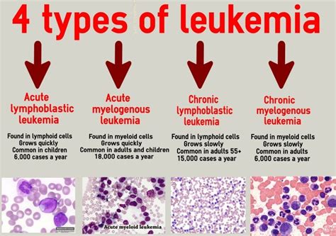 Leukemia – A type of Blood Cancer