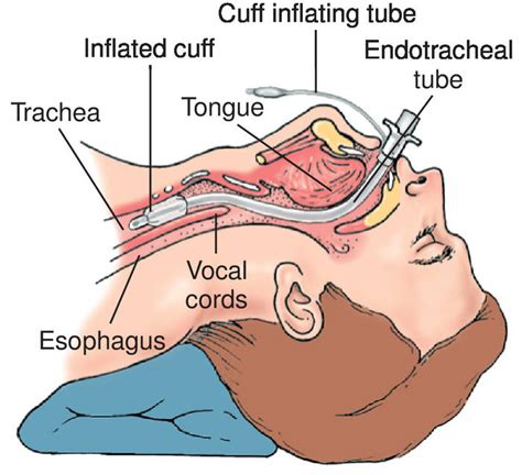 endotracheal-tube-ett-sizes-proper-placement-and-useful-airway ...