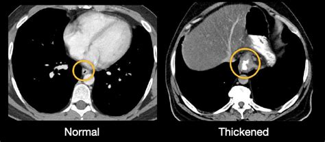 Abdominal CT: oesophagus and stomach • LITFL • Radiology