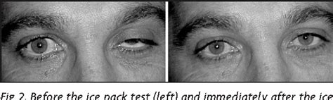 [PDF] Ice pack test in the diagnosis of myasthenia gravis. | Semantic ...