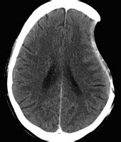 Malignant: Malignant Mca Syndrome