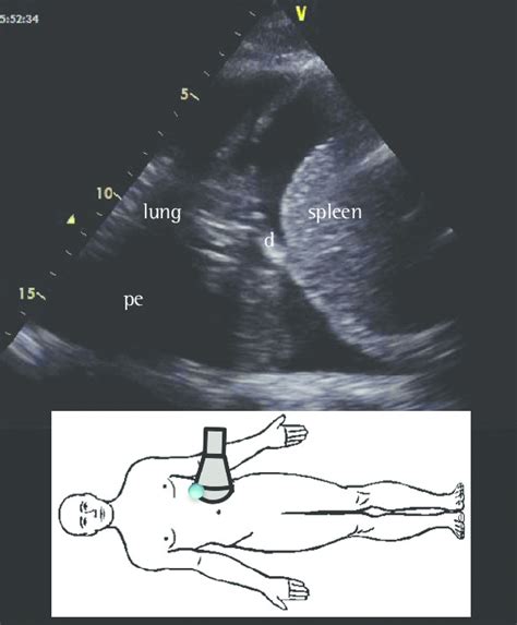 Pleural Effusion Ultrasound Images