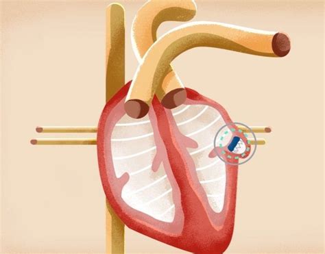 Left Atrial Appendage Closure | Advocate Heart Institute | Chicago ...