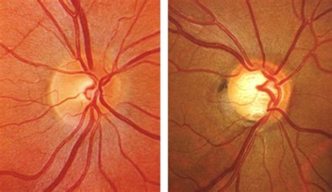 What is Glaucoma? - Pietermaritzburg Eye Hospital