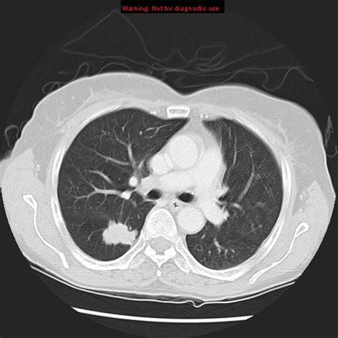 Lung mass CT scan - wikidoc