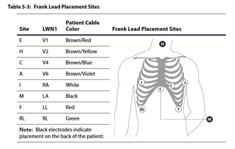 [DIAGRAM] Ecg Lead Placement Guide Diagram - MYDIAGRAM.ONLINE