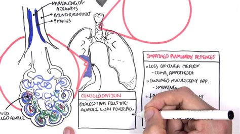 PART I - Pneumonia (Overview, Lobar and Bronchopneumonia) | Doovi