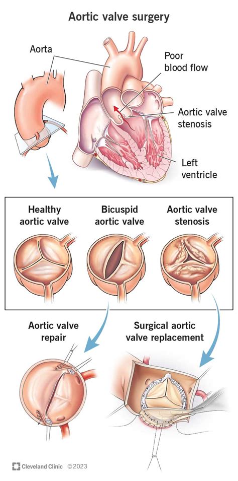 Aortic Valve Surgery: Procedure Details & Benefits