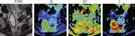 Discrimination between Metastatic and Nonmetastatic Mesorectal Lymph ...