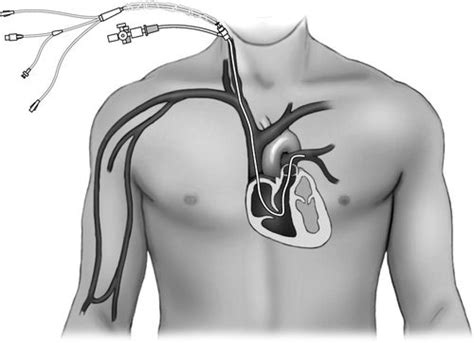 Pulmonary Artery Pressure and Thermodilution Cardiac Output Monitoring ...