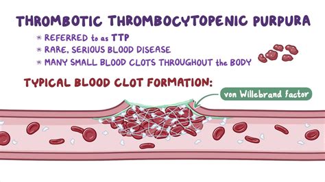 Púrpura trombocitopénica trombótica (NORD): Vídeo | Osmosis