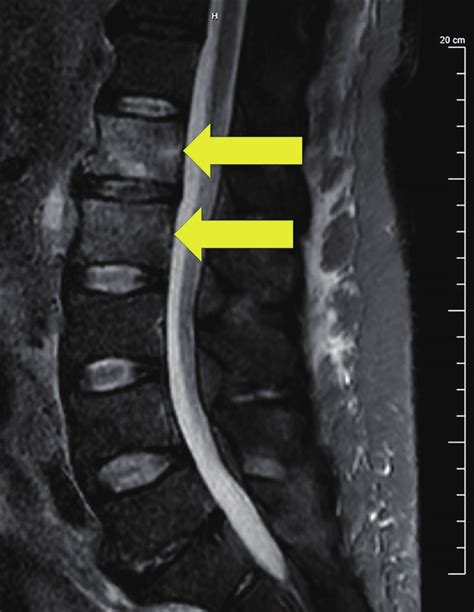 T2-weighted fat suppression image of lumbar spine MRI showed marrow ...