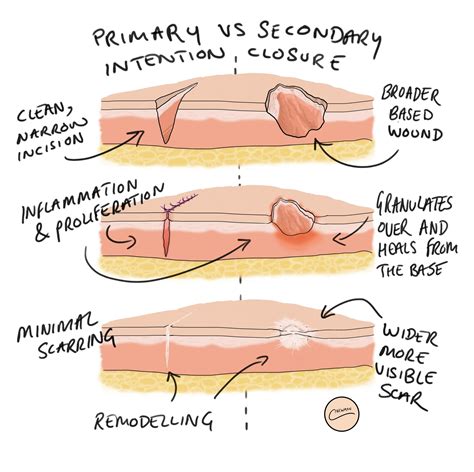 Scar Prevention/ Treatment — Dermatology Skin Cancer Experts