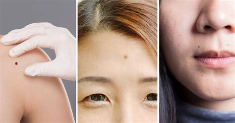 Know about moles on your body and their meaning - OrissaPOST