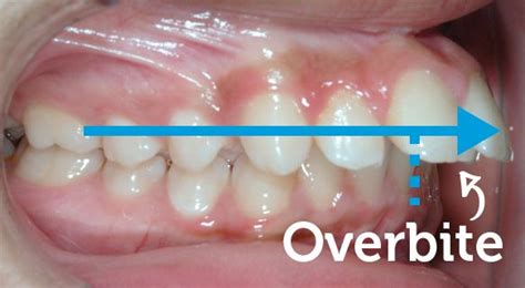 How To Fix An Overbite Without Braces : Overbite Underbite Treatment ...