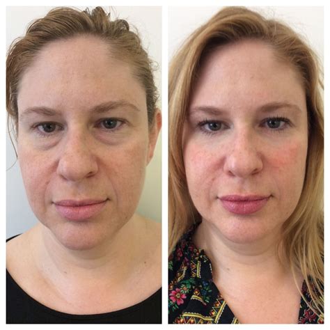 Westside Aesthetics Non Surgical Face Lift | Cosmetic surgery ...