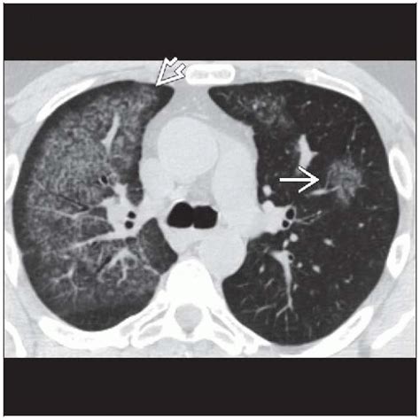 Diffuse Alveolar Hemorrhage | Radiology Key