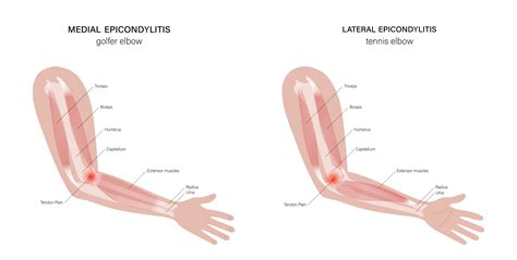 Tennis Elbow Vs. Golfer’s Elbow: Differences, Symptoms and Treatment