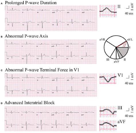 Knowledge Of ECG ?Figure: Common ECG Abnormalities? ?Guys, 41% OFF