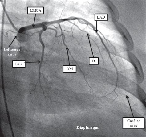 Coronary Angiogram : All You Need To Know - CVSKL