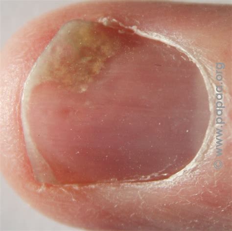 Nail psoriasis: what are the most common changes that occur?