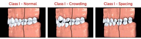 Classification Of Bites | Anderson & Moopen Orthodontics