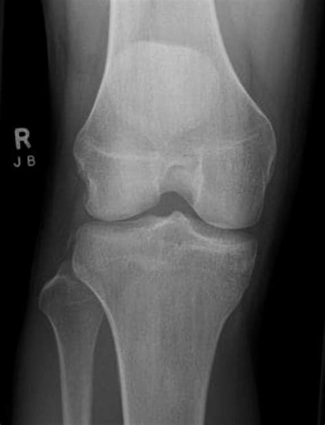 ICE 006: Knee injury X-ray • LITFL • ICE Clinical Cases