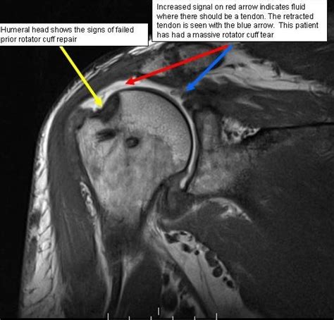 Boston Shoulder Institute – MRI rotator cuff tear